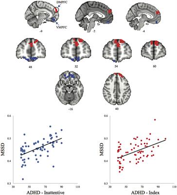 Resting-State Brain Signal Variability in Prefrontal Cortex Is Associated With ADHD Symptom Severity in Children